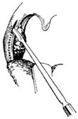 扁桃体摘除术图片