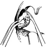 扁桃体摘除术图片
